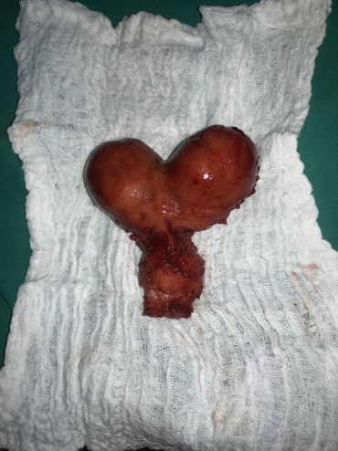 Cirugía de Malformaciones Uterinas
