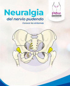Neuralgia del Pudendo !